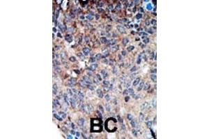 Formalin-fixed and paraffin-embedded human cancer tissue reacted with the primary antibody, which was peroxidase-conjugated to the secondary antibody, followed by DAB staining. (NME1 antibody  (N-Term))