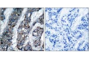 Immunohistochemistry analysis of paraffin-embedded human breast carcinoma, using HER2 (Phospho-Tyr1248) Antibody.