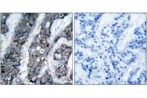 Immunohistochemistry analysis of paraffin-embedded human breast carcinoma, using HER2 (Phospho-Tyr1248) Antibody. (ErbB2/Her2 antibody  (pTyr1248))