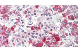 Immunohistochemistry of paraffin-embedded Human gastric cancer using CPB1 Polyclonal Antibody at dilution of 1:60. (CPB1 antibody)