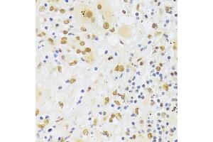 Immunohistochemistry of paraffin-embedded human liver cancer using HNRNPA1 Antibody (ABIN5975570) at dilution of 1/100 (40x lens). (HNRNPA1 antibody)