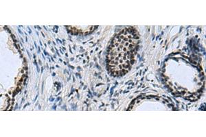 Immunohistochemistry of paraffin-embedded Human prost at e cancer tissue using CCAR2 Polyclonal Antibody at dilution of 1:40(x200) (CCAR2 antibody)