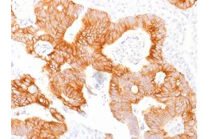 Formalin-fixed, paraffin-embedded human Colorectal Carcinoma stained with Ep-CAM Mouse Monoclonal Antibody (EGP40/1798). (EpCAM antibody  (Extracellular Domain))