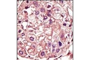 Formalin-fixed and paraffin-embedded human cancer tissue reacted with the primary antibody, which was peroxidase-conjugated to the secondary antibody, followed by AEC staining. (TGFBR1 antibody  (AA 134-163))