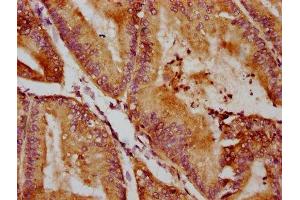 IHC image of ABIN7170939 diluted at 1:400 and staining in paraffin-embedded human endometrial cancer performed on a Leica BondTM system. (QSOX1 antibody  (AA 101-175))