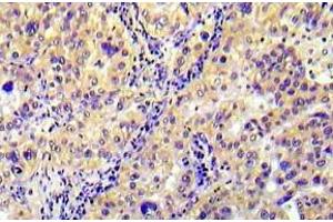 Immunohistochemistry (IHC) analyzes of p-AMPK1 antibody in paraffin-embedded human lung carcinoma tissue. (PRKAB1 antibody  (pSer182))