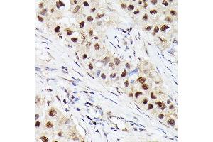 Immunohistochemistry of paraffin-embedded human breast cancer using [KO Validated] CDK4 Rabbit mAb  at dilution of 1:100 (40x lens). (CDK4 antibody)