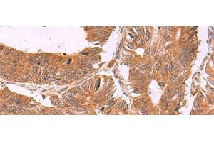 Immunohistochemistry of paraffin-embedded Human colorectal cancer tissue using ZBTB33 Polyclonal Antibody at dilution of 1:30(x200) (ZBTB33 antibody)