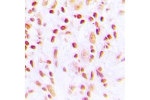 Immunohistochemical analysis of CHK2 (pT387) staining in human lung cancer formalin fixed paraffin embedded tissue section. (CHEK2 antibody  (pSer387))