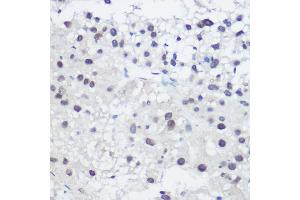 Immunohistochemistry of paraffin-embedded human liver cancer using GA Rabbit pAb (ABIN3022563, ABIN3022564, ABIN3022565, ABIN1679943 and ABIN6218905) at dilution of 1:200 (40x lens). (GADD45A antibody  (AA 1-165))