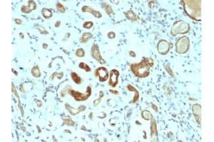 Formalin-fixed, paraffin-embedded human Renal Cell Carcinoma stained with STAT3 Mouse Monoclonal Antibody (STAT3/2409). (STAT3 antibody)