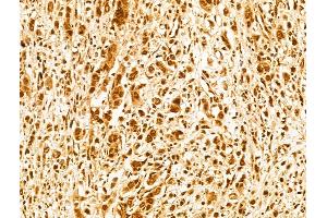 ABIN7094227 and ABIN7098274 at 1/100 staining Human gastric cancer by IHC-P. (FBXW11 antibody  (C-Term))