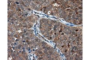 Immunohistochemical staining of paraffin-embedded Adenocarcinoma of ovary tissue using anti-NIT1 mouse monoclonal antibody. (Nitrilase 1 antibody)