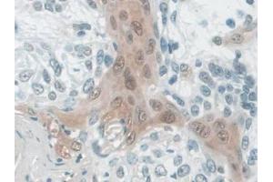 IHC-P analysis of Human Skin cancer Tissue, with DAB staining. (CALML5 antibody  (AA 1-146))