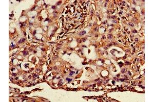 Immunohistochemistry of paraffin-embedded human lung cancer using ABIN7145421 at dilution of 1:100 (beta-2 Microglobulin antibody  (AA 21-119))