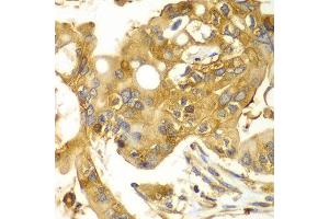 Immunohistochemistry of paraffin-embedded human liver cancer using CAPNS1 antibody at dilution of 1:100 (x40 lens). (Calpain S1 antibody)