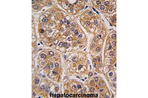 Formalin-fixed and paraffin-embedded human hepatocarcinomareacted with AKR1A1 polyclonal antibody , which was peroxidase-conjugated to the secondary antibody, followed by AEC staining. (AKR1A1 antibody  (C-Term))