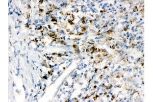 IHC(P): Human Intestinal Cancer Tissue (PPT1 antibody  (C-Term))