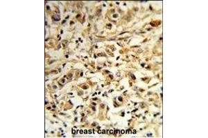 Forlin-fixed and paraffin-embedded hun breast carcino reacted with T2B Antibody (N-term), which was peroxidase-conjugated to the secondary antibody, followed by DAB staining.