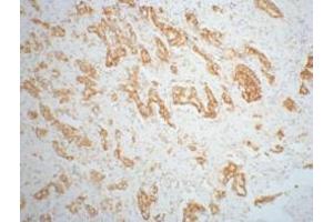 IHC staining of mouse prostate adenocarcinoma tissue, diluted at 1:200.