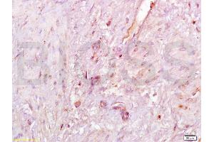 Formalin-fixed and paraffin embedded human endometrial carcinoma labeled with Anti-SIRT1 Polyclonal Antibody, Unconjugated (ABIN729853) at 1:200, followed by conjugation to the secondary antibody and DAB staining (SIRT1 antibody  (AA 101-200))