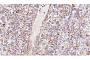 ABIN6273205 at 1/100 staining Human lymph cancer tissue by IHC-P.