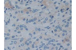 DAB staining on IHC-P;;Samples: Human Prostate cancer Tissue (Reelin antibody  (AA 2398-2608))