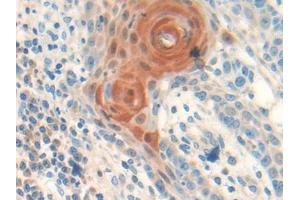 DAB staining on IHC-P; Samples: Human Skin cancer Tissue (Follistatin antibody  (AA 35-283))