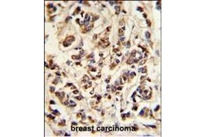 ATP6V1A Antibody (Center) (ABIN653735 and ABIN2843040) IHC analysis in formalin fixed and paraffin embedded breast carcinoma followed by peroxidase conjugation of the secondary antibody and DAB staining. (ATP6V1A antibody  (AA 441-468))