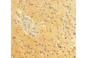 Immunohistochemistry of paraffin-embedded human glioma using ABIN7164055 at dilution of 1:100 (POU3F2 antibody  (AA 1-443))
