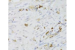 Immunohistochemistry of paraffin-embedded Human adenomyosis using LSP1 Polyclonal Antibody at dilution of 1:100 (40x lens). (LSP1 antibody)