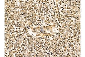 hnRNP Q Mouse Monoclonal Antibody at 1/100 staining human gastric cancer by IHC-P.