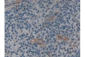 Detection of IL2Ra in Human Skin cancer Tissue using Polyclonal Antibody to Interleukin 2 Receptor Alpha (IL2Ra) (CD25 antibody  (AA 22-213))