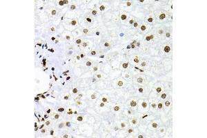 Immunohistochemistry of paraffin-embedded human liver injury using NFKB2 Antibody (ABIN1873900) at dilution of 1:100 (40x lens). (NFKB2 antibody)