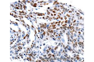 Immunohistochemistry of Human ovarian cancer using MUTYH Polyclonal Antibody at dilution of 1:60 (MUTYH antibody)