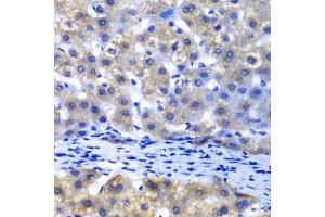 Immunohistochemistry of paraffin-embedded human liver injury using PSMD8 antibody (ABIN5974182) at dilution of 1/100 (40x lens). (PSMD8 antibody)