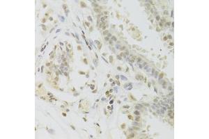 Immunohistochemistry of paraffin-embedded human breast using PRPF3 Antibody (ABIN5973192) at dilution of 1/100 (40x lens). (PRPF3 antibody)