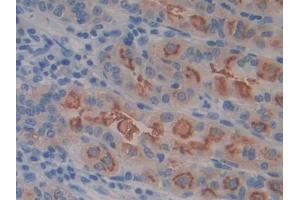 IHC-P analysis of Human Stomach cancer Tissue, with DAB staining. (SLC3A2 antibody  (AA 213-349))