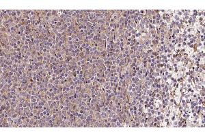 ABIN6273213 at 1/100 staining Human lymph cancer tissue by IHC-P. (COQ9 antibody  (Internal Region))