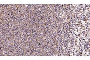 ABIN6273213 at 1/100 staining Human lymph cancer tissue by IHC-P.