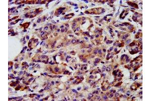 IHC image of ABIN7169389 diluted at 1:200 and staining in paraffin-embedded human pancreatic cancer performed on a Leica BondTM system. (PON3 antibody  (AA 269-335))
