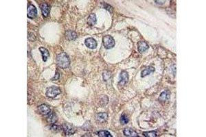 IHC analysis of FFPE human hepatocarcinoma tissue stained with AFP antibody (alpha Fetoprotein antibody  (AA 300-329))