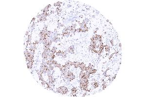Epitheloid mesothelioma with membranous Upk3b staining of variable intensity in most tumor cells (Uroplakin 3B antibody)