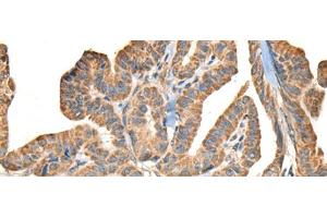 Immunohistochemistry of paraffin-embedded Human thyroid cancer tissue using SLAMF7 Polyclonal Antibody at dilution of 1:30(x200) (SLAMF7 antibody)