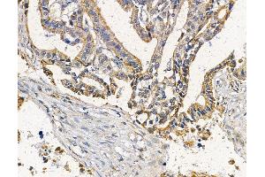 ABIN6265909 and ABIN6278129 at 1/100 staining human liver cancer by IHC-P.