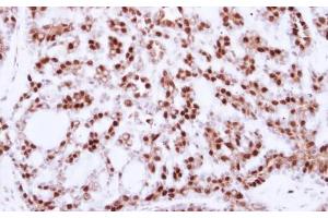 IHC-P Image Immunohistochemical analysis of paraffin-embedded human breast cancer, using CDC25C, antibody at 1:250 dilution.