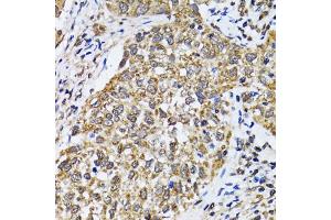 Immunohistochemistry of paraffin-embedded human lung cancer using TP53 antibody (ABIN5973383) at dilution of 1/100 (40x lens). (p53 antibody)