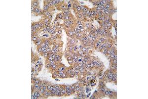 Formalin-fixed and raffin-embedded human prostata carcinoma tissue reacted with K4 antibody (N-term), which was peroxidase-conjugated to the secondary antibody, followed by DAB staining. (PAK4 antibody  (N-Term))