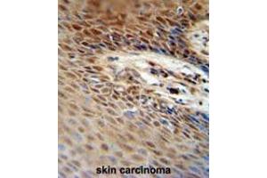 ZNF324B antibody (C-term) immunohistochemistry analysis in formalin fixed and paraffin embedded human skin carcinoma followed by peroxidase conjugation of the secondary antibody and DAB staining. (ZNF324B antibody  (C-Term))