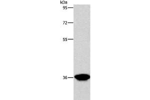 Western Blot analysis of Human liver cancer tissue using AKR1D1 Polyclonal Antibody at dilution of 1:650 (AKR1D1 antibody)